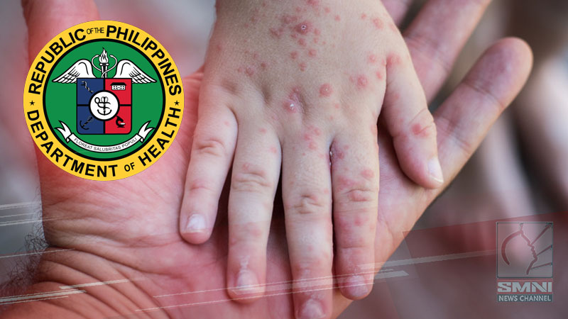 Measles at rubella cases ngayong 2024, 5 beses mas mataas vs 2023