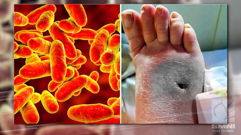 Deadly flesh-eating bacteria wreak havoc in Japan