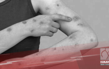 Mpox