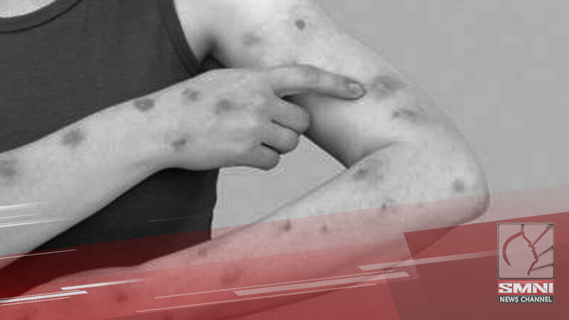 Bacolod City Health Office nanawagan sa publiko vs. Mpox