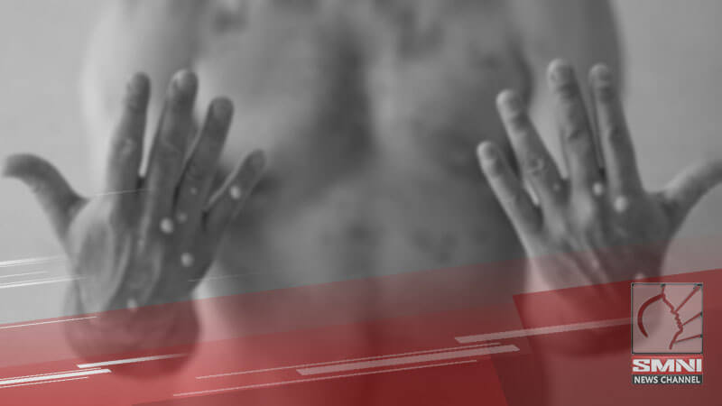 Pagtaas ng kaso ng Mpox sa Mindanao umabot na sa ilang probinsiya