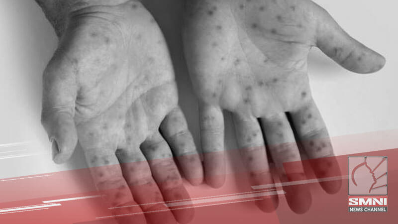 Iloilo City kinumpirma ang unang kaso ng monkeypox