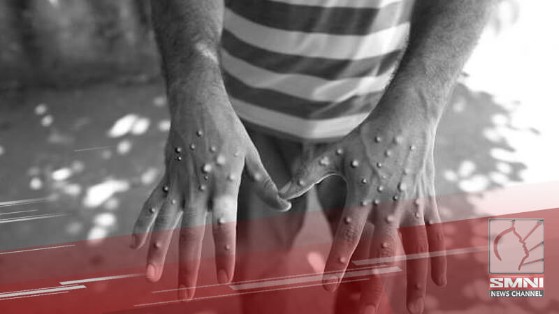 3 Mpox cases kumpirmado sa Sarangani