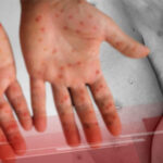 Mpox