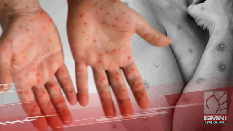 Mpox nakapasok na sa lalawigan ng Aurora
