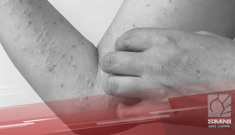 Mpox