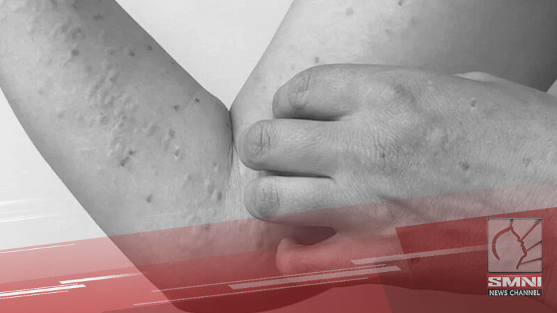 Bacolod City, nakapagtala ng kauna-unahang kaso ng Mpox