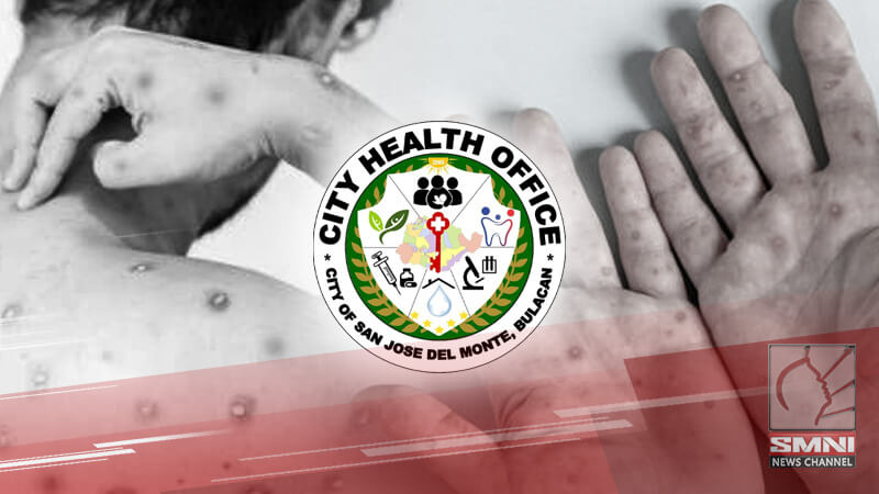 San Jose del Monte may 2 kaso ng Mpox