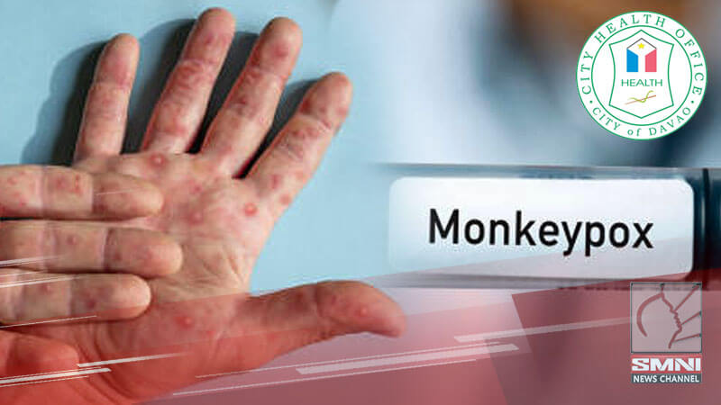 Davao City, alerto pa rin sa Mpox sa kabila ng mga gumaling na pasyente